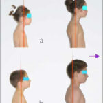 Can the Treatment of Dental Malocclusions Affect the Posture in Children?